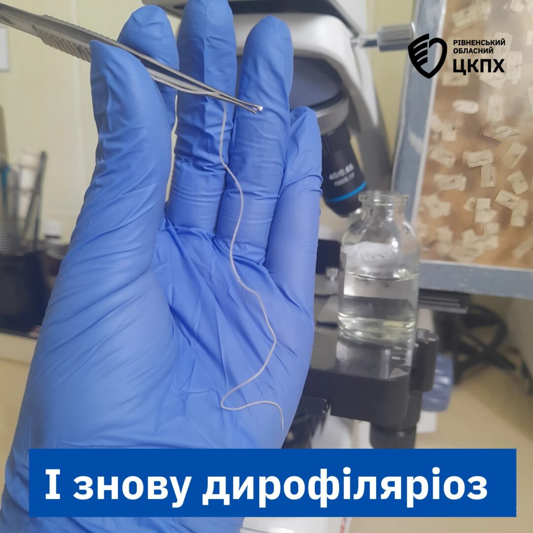 dyfor 1 - На Рівненщині лікарі видалили з ока жінки 11-сантиметрового гельмінта - rai.ua