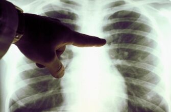 Що таке пневмонія і чому її варто запобігати