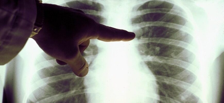 Що таке пневмонія і чому її варто запобігати