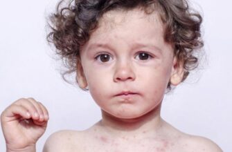 Краснуха - що варто знати про захворювання?