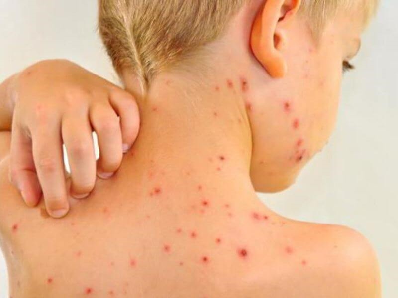 kram - Краснуха: що варто знати про захворювання? - rai.ua