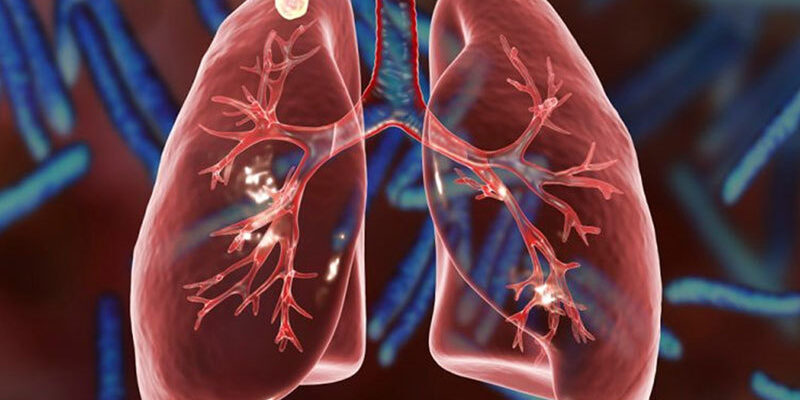 У грудні 2025 року в Україні зареєстровано 1332 людини з туберкульозом