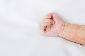 Кір - одна з найзаразливіших інфекційних хвороб у світі