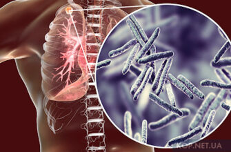 Чи захищає вакцина від туберкульозу: пояснюють медики