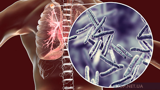 Чи захищає вакцина від туберкульозу: пояснюють медики