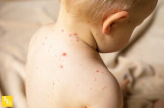 Кір на Прикарпатті: захворюваність знижується, але під ударом залишаються діти. Відео