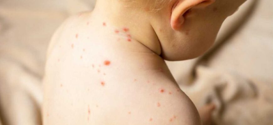 Кір на Прикарпатті: захворюваність знижується, але під ударом залишаються діти. Відео