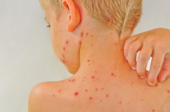 В Україні щороку реєструють понад 50 000 випадків вітряної віспи