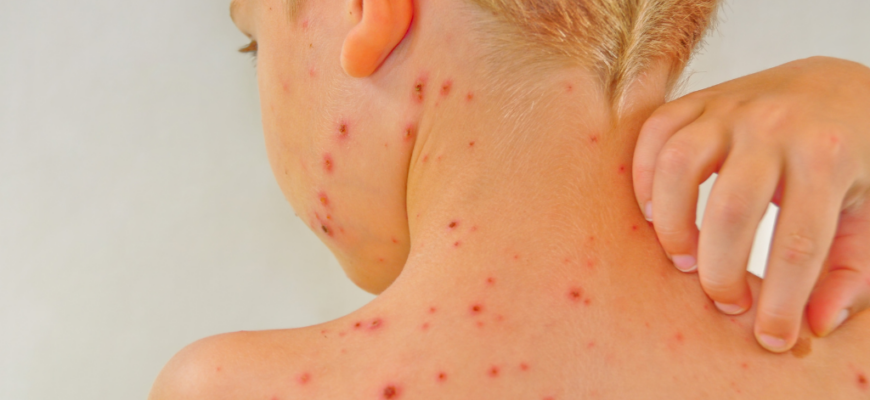 В Україні щороку реєструють понад 50 000 випадків вітряної віспи