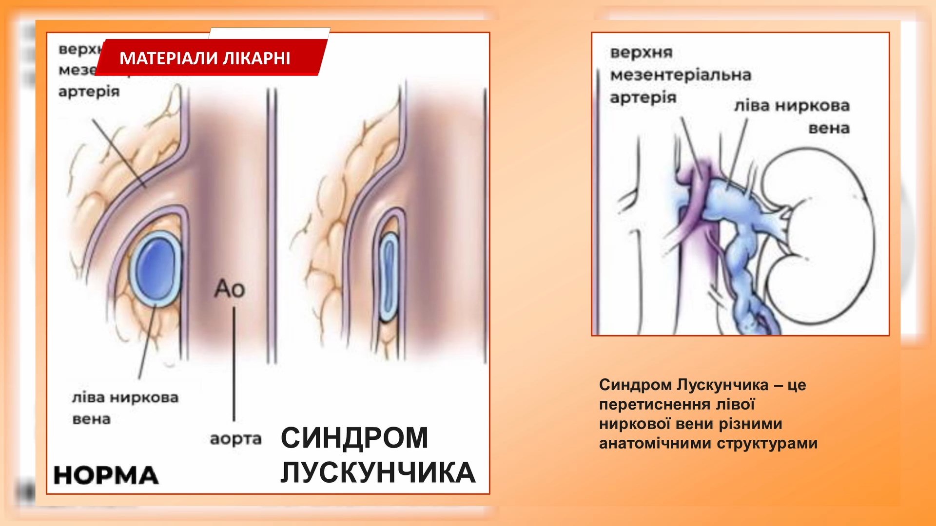 ipmkm - Хірурги Івано-Франківської ЦМКЛ виконали надскладну та рідкісну операцію. Відео - rai.ua