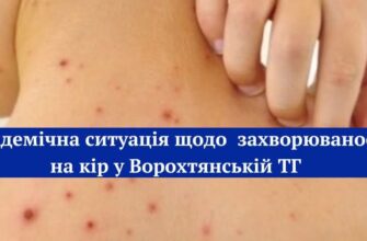 У Ворохтянській громаді зареєстровано 4 випадки захворювання на кір