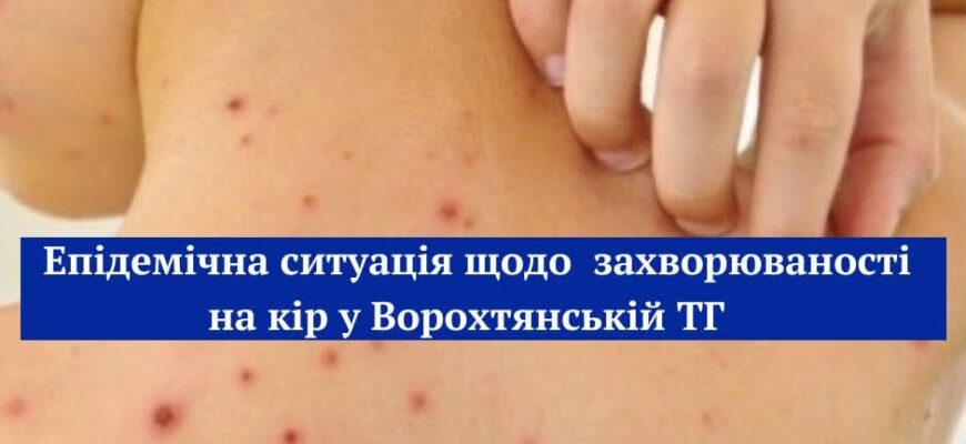 У Ворохтянській громаді зареєстровано 4 випадки захворювання на кір
