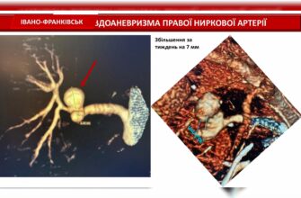 В Івано-Франківській ЦМКЛ успішно провели надскладну операцію. Відео