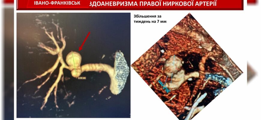В Івано-Франківській ЦМКЛ успішно провели надскладну операцію. Відео