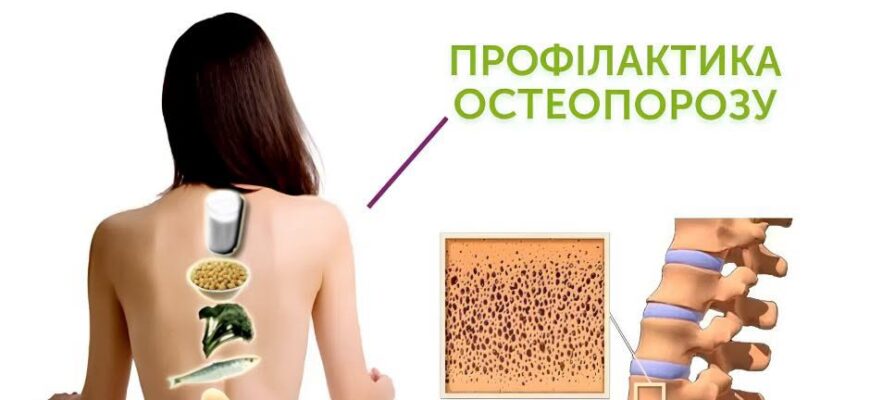 Остеопороз: захворювання, яке часто виявляють після першого перелому